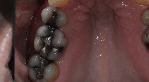 CarolinaPines_Before&AfterPhotos_3